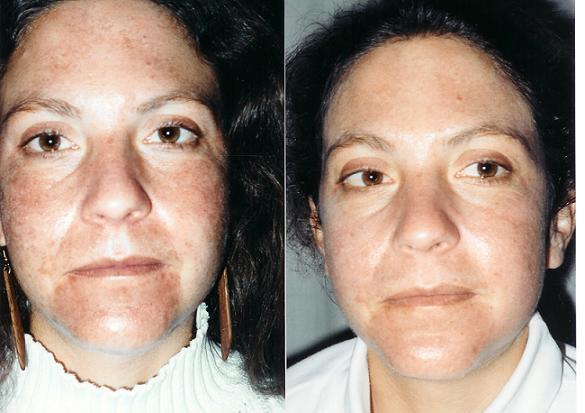 Hyperpigmentation